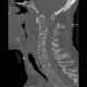 Osteolytic metastasis of cervical spine, fracture of dens axis, C2: CT - Computed tomography